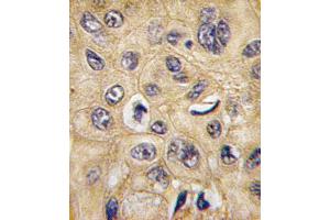 Formalin-fixed and paraffin-embedded human hepatocarcinoma tissue reacted with TSC2 Antibody  (ABIN390324 and ABIN2840755) , which was peroxidase-conjugated to the secondary antibody, followed by DAB staining. (Tuberin antibody  (AA 1776-1805))