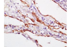 Formalin-fixed and paraffin embedded human lung carcinoma labeled with Rabbit Anti-CK18 Polyclonal Antibody,Unconjugated  at 1:200 followed by conjugation to the secondary antibody and DAB staining (Cytokeratin 18 antibody  (AA 301-423))