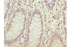 Immunohistochemistry of paraffin-embedded human colon cancer using ABIN7176363 at dilution of 1:100 (ZNF544 antibody  (AA 1-230))