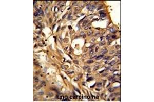 Formalin-fixed and paraffin-embedded human lung carcinoma reacted with ETFDH Antibody (N-term), which was peroxidase-conjugated to the secondary antibody, followed by DAB staining. (ETFDH antibody  (N-Term))