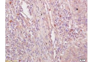 Formalin-fixed and paraffin embedded human lung carcinoma labeled with Rabbit Anti VE Cadherin/VECD/CD144 Polyclonal Antibody, Unconjugated (ABIN1387250) at 1:200 followed by conjugation to the secondary antibody and DAB staining (Cadherin 5 antibody  (AA 251-320))
