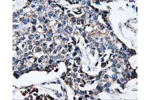 Immunohistochemical staining of paraffin-embedded Adenocarcinoma of breast tissue using anti-ATP5B mouse monoclonal antibody. (ATP5B antibody)