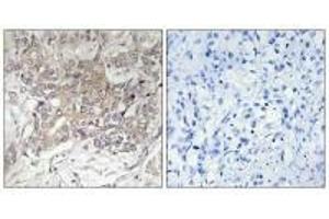Immunohistochemistry analysis of paraffin-embedded human liver carcinoma tissue using GCNT3 antibody. (GCNT3 antibody)