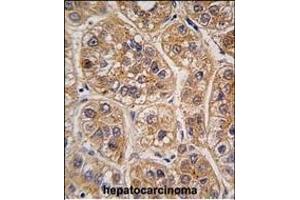 Formalin-fixed and paraffin-embedded human hepatocarcinoma tissue reacted with AKR1A1 antibody (C-term) (ABIN389204 and ABIN2837921) , which was peroxidase-conjugated to the secondary antibody, followed by DAB staining. (AKR1A1 antibody  (C-Term))