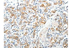 The image on the left is immunohistochemistry of paraffin-embedded Human gastric cancer tissue using (TEP1 Antibody) at dilution 1/40, on the right is treated with synthetic peptide. (TEP1 antibody)