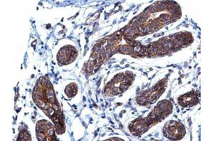 IHC-P Image BCAR1 antibody [N2C2], Internal detects BCAR1 protein at cytoplasm on human breast carcinoma by immunohistochemical analysis. (BCAR1 antibody  (Internal Region))