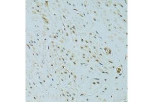 Immunohistochemistry of paraffin-embedded human uterine cancer using NHEJ1 antibody.