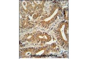 CCD antibody (C-term) (ABIN654259 and ABIN2844079) immunohistochemistry analysis in formalin fixed and paraffin embedded human colon carcinoma followed by peroxidase conjugation of the secondary antibody and DAB staining. (CEP89 antibody  (C-Term))