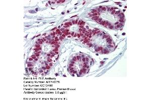 Rabbit Anti-FUS Antibody  Paraffin Embedded Tissue: Human Breast Antibody Concentration: 5 ug/ml