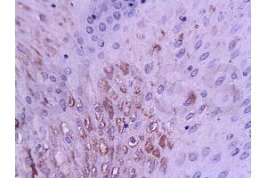 Formalin-fixed and paraffin embedded human esophageal cancer tissue labeled with Anti-WIG 1/PAG608 Monoclonal Antibody, Unconjugated at 1:200 followed by conjugation to the secondary antibody and DAB staining (ZMAT3 antibody  (AA 70-120))