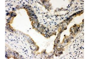 IHC-P: Rad51 antibody testing of human intestine cancer tissue (RAD51 antibody  (AA 1-258))