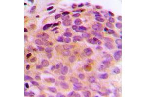 Immunohistochemical analysis of BAG4 staining in human breast cancer formalin fixed paraffin embedded tissue section. (BAG4 antibody  (C-Term))