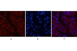 Immunofluorescence analysis of human stomach cancer tissue.