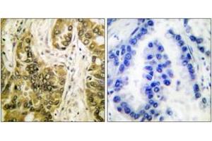 Immunohistochemistry analysis of paraffin-embedded human lung carcinoma tissue, using Galectin 3 Antibody. (Galectin 3 antibody  (AA 141-190))