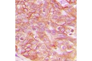 Immunohistochemical analysis of Claudin 3 staining in human breast cancer formalin fixed paraffin embedded tissue section.