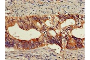 Immunohistochemistry of paraffin-embedded human colon cancer using ABIN7161673 at dilution of 1:100 (Olfactomedin 1 antibody  (AA 374-441))
