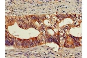 Immunohistochemistry of paraffin-embedded human colon cancer using ABIN7161673 at dilution of 1:100