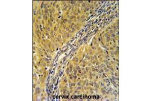DYNC1LI2 Antibody immunohistochemistry analysis in formalin fixed and paraffin embedded human cervix carcinoma followed by peroxidase conjugation of the secondary antibody and DAB staining.