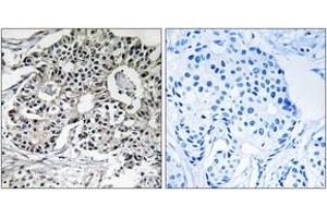 Immunohistochemistry analysis of paraffin-embedded human breast carcinoma, using PXMP2 Antibody. (PXMP2 antibody  (AA 38-87))