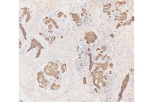 IHC analysis of Cytokeratin 19 using anti-Cytokeratin 19 antibody (ABIN3043288). (Cytokeratin 19 antibody  (C-Term))