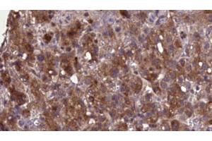 ABIN6276896 at 1/100 staining Human liver cancer tissue by IHC-P. (SLC22A6 antibody  (C-Term))
