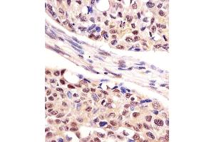 Antibody staining UCHL1 in human lung adenocarcinoma tissue sections by Immunohistochemistry (IHC-P - paraformaldehyde-fixed, paraffin-embedded sections). (UCHL1 antibody  (C-Term))