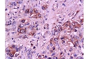 Formalin-fixed and paraffin embedded human gastric carcinoma tissue labeled with Anti-E-Selectin Polyclonal Antibody, Unconjugated (ABIN674244) at 1:200 followed by conjugation to the secondary antibody and DAB staining (Selectin E/CD62e antibody  (AA 501-612))