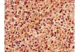 Immunohistochemistry of paraffin-embedded human glioma using ABIN7159758 at dilution of 1:100