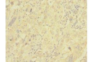Immunohistochemistry of paraffin-embedded human liver cancer using ABIN7147644 at dilution of 1:100 (NG2 antibody  (AA 1950-2210))