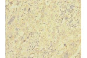 Immunohistochemistry of paraffin-embedded human liver cancer using ABIN7147644 at dilution of 1:100 (NG2 antibody  (AA 1950-2210))