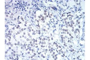 Immunohistochemical analysis of paraffin-embedded bladder cancer tissues using DDX5 mouse mAb with DAB staining.