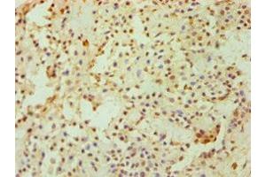 Immunohistochemistry of paraffin-embedded human breast cancer using ABIN7149890 at dilution of 1:100 (DKK4 antibody  (AA 19-224))