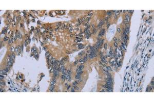 Immunohistochemistry of paraffin-embedded Human colon cancer using CEBPD Polyclonal Antibody at dilution of 1:40 (CEBPD antibody)