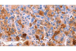 Immunohistochemistry of paraffin-embedded Human liver cancer tissue using ERN2 Polyclonal Antibody at dilution 1:40 (ERN2 antibody)