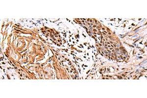 Immunohistochemistry of paraffin-embedded Human esophagus cancer tissue using ITPR2 Polyclonal Antibody at dilution of 1:65(x200) (ITPR2 antibody)
