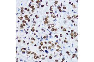 Immunohistochemistry of paraffin-embedded human mammary cancer using Acetyl-Histone H3-K9 antibody (ABIN7267675) at dilution of 1:200 (40x lens). (Histone 3 antibody  (H3K9))