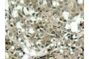 Immunohistochemistry analyzes of c-Abl antibody in paraffin-embedded human breast carcinoma tissue. (ABL1 antibody)