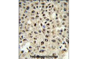 Formalin-fixed and paraffin-embedded human hepatocarcinoma reacted with SSB Antibody (N-term), which was peroxidase-conjugated to the secondary antibody, followed by DAB staining. (SSB antibody  (N-Term))