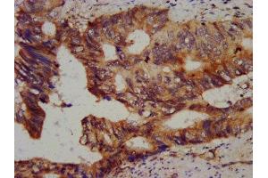 IHC image of ABIN7147529 diluted at 1:800 and staining in paraffin-embedded human colon cancer performed on a Leica BondTM system. (CHMP5 antibody  (AA 1-219))