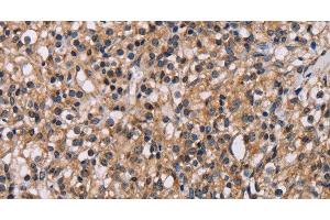 Immunohistochemistry of paraffin-embedded Human prostate cancer using GNL3 Polyclonal Antibody at dilution of 1:60 (Nucleostemin antibody)