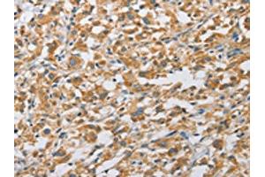 The image on the left is immunohistochemistry of paraffin-embedded Human thyroid cancer tissue using ABIN7128493(ARHGAP5 Antibody) at dilution 1/25, on the right is treated with fusion protein. (ARHGAP5 antibody)