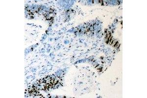 Immunohistochemical analysis of Cyclin C staining in human colon cancer formalin fixed paraffin embedded tissue section. (Cyclin C antibody)
