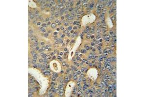 Immunohistochemistry analysis in human prostate carcinoma (formalin-fixed, paraffin-embedded) using MICAL-like protein 1 Antibody (C-term), followed by peroxidase conjugation of the secondary antibody and DAB staining. (MICAL-Like 1 antibody  (C-Term))