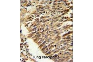 Immunohistochemistry (Paraffin-embedded Sections) (IHC (p)) image for anti-Hypoxia Inducible Factor 1, alpha Subunit (Basic Helix-Loop-Helix Transcription Factor) (HIF1A) (AA 519-547) antibody (ABIN652389)