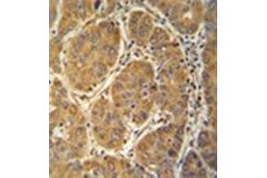 Immunohistochemistry analysis in formalin fixed and paraffin embedded human hepatocarcinoma reacted with MCEE Antibody (C-term) followed which peroxidase conjugated to the secondary antibody and followed by  DAB staining. (MCEE antibody  (C-Term))