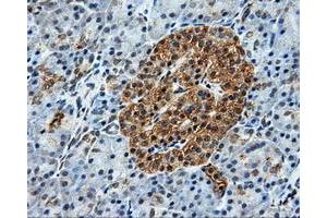 Immunohistochemical staining of paraffin-embedded Adenocarcinoma of breast tissue using anti-BRAF mouse monoclonal antibody. (BRAF antibody)