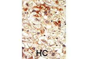 Formalin-fixed and paraffin-embedded human hepatocellular carcinoma tissue reacted with PCTK2 polyclonal antibody  , which was peroxidase-conjugated to the secondary antibody, followed by DAB staining. (CDK17 antibody  (N-Term))