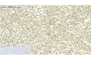 Immunohistochemistry of paraffin-embedded Human breast cancer tissue using ABCB5 Monoclonal Antibody at dilution of 1:200. (ABCB5 antibody)