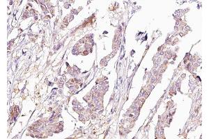 ABIN6267680 at 1/100 staining human Breast carcinoma tissue sections by IHC-P. (BAD antibody  (pSer155))