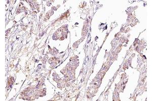 ABIN6267680 at 1/100 staining human Breast carcinoma tissue sections by IHC-P.